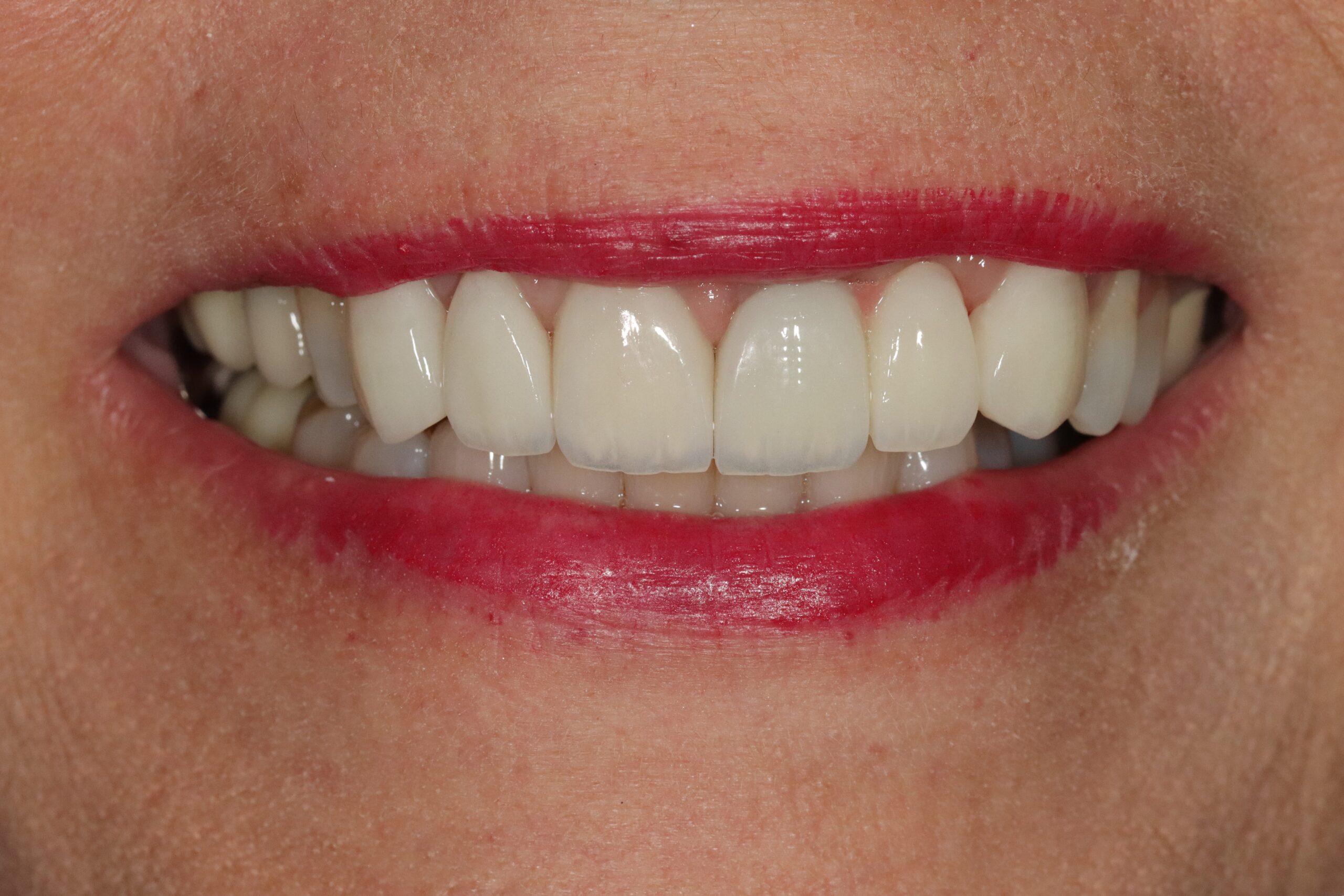 Case 3, after treatment