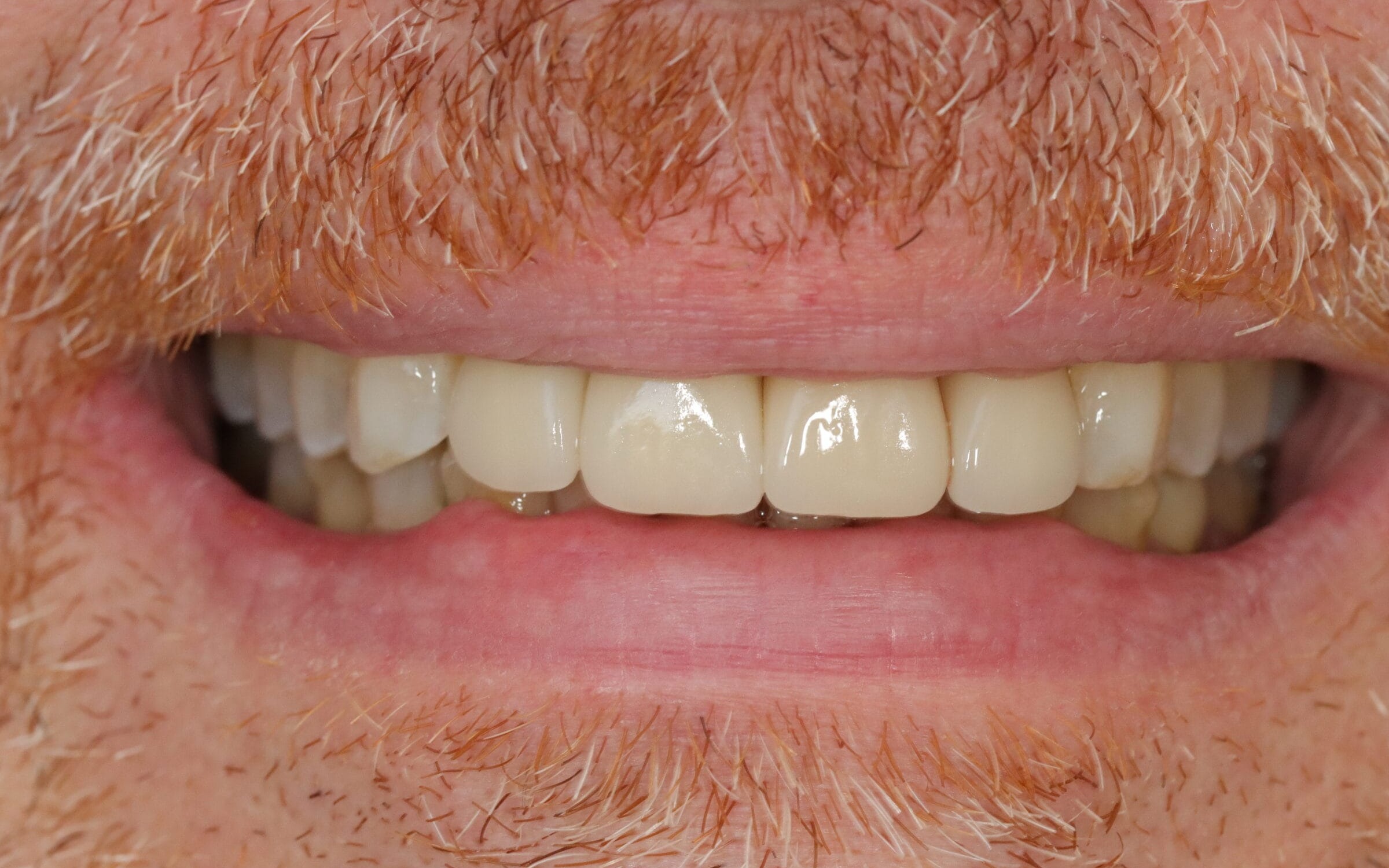 Case 17, after treatment