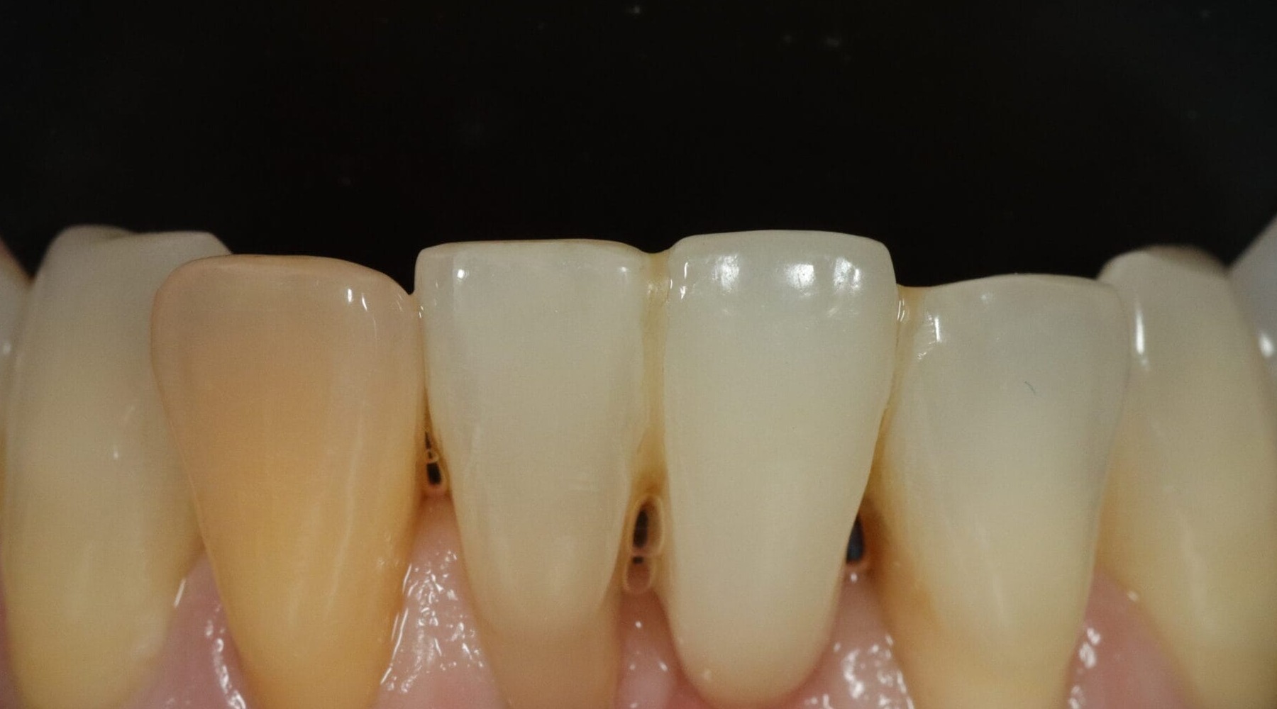 Case 15, before treatment