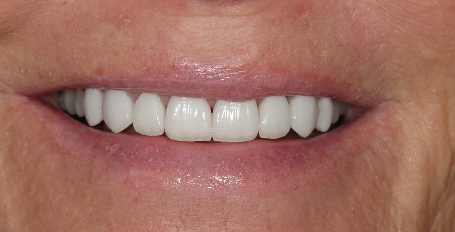 Case 13, after treatment