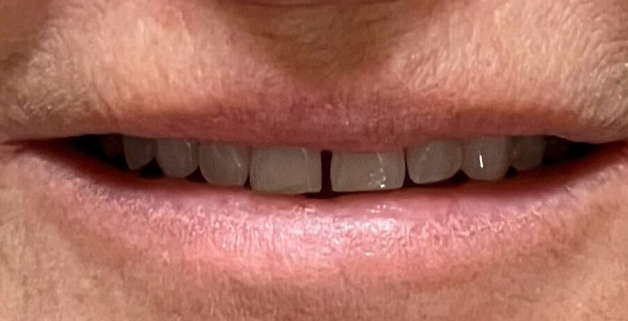 Case 13, before treatment