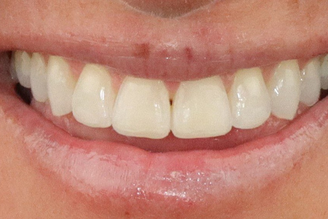 Case 22, after treatment