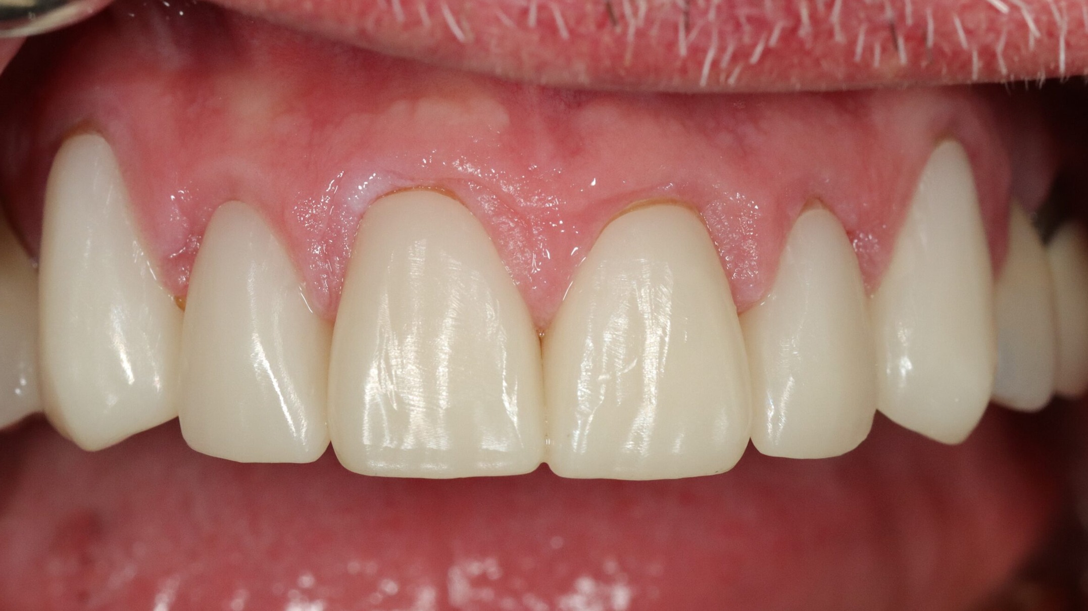 Case 19, after treatment