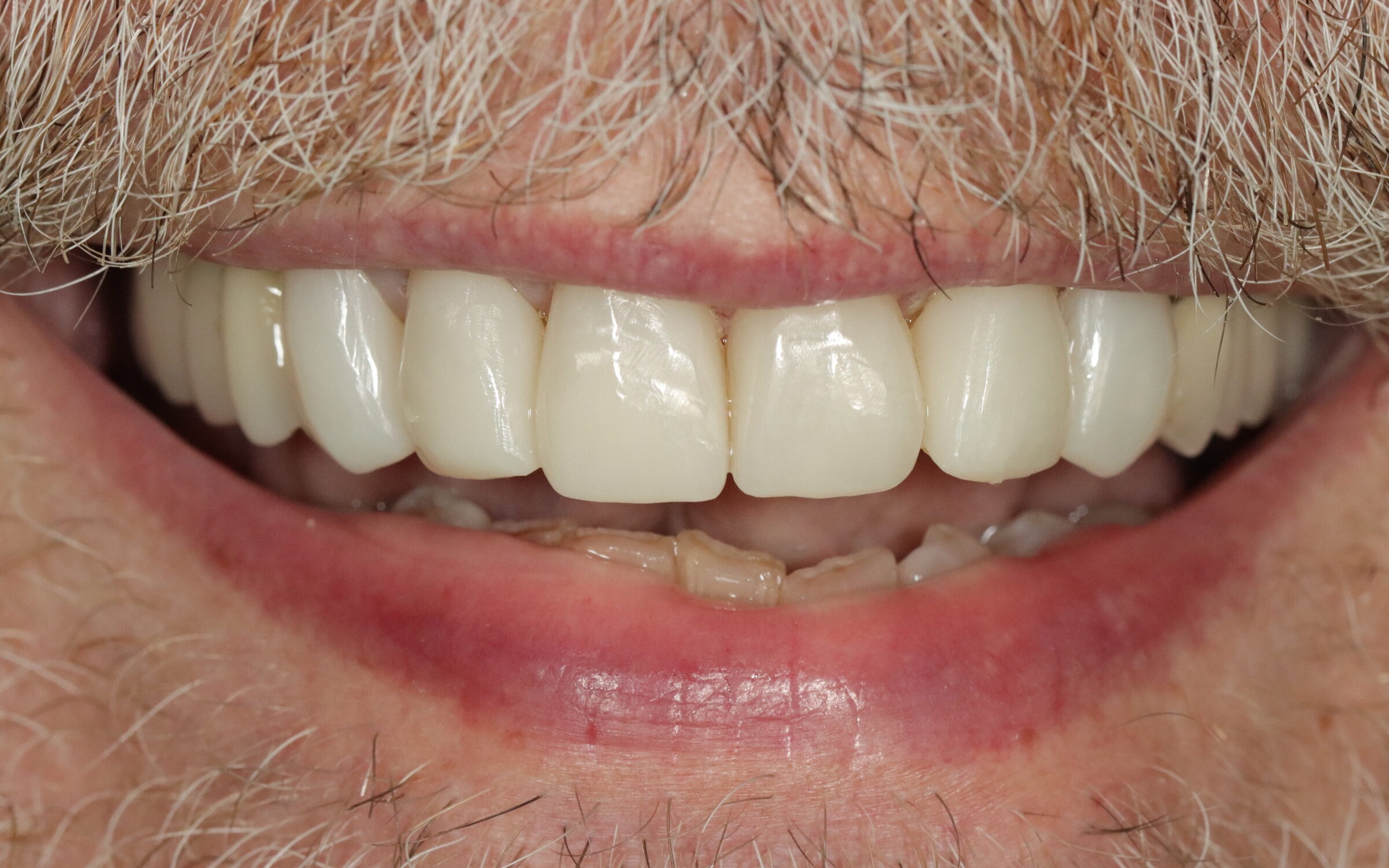 Case 18, after treatment