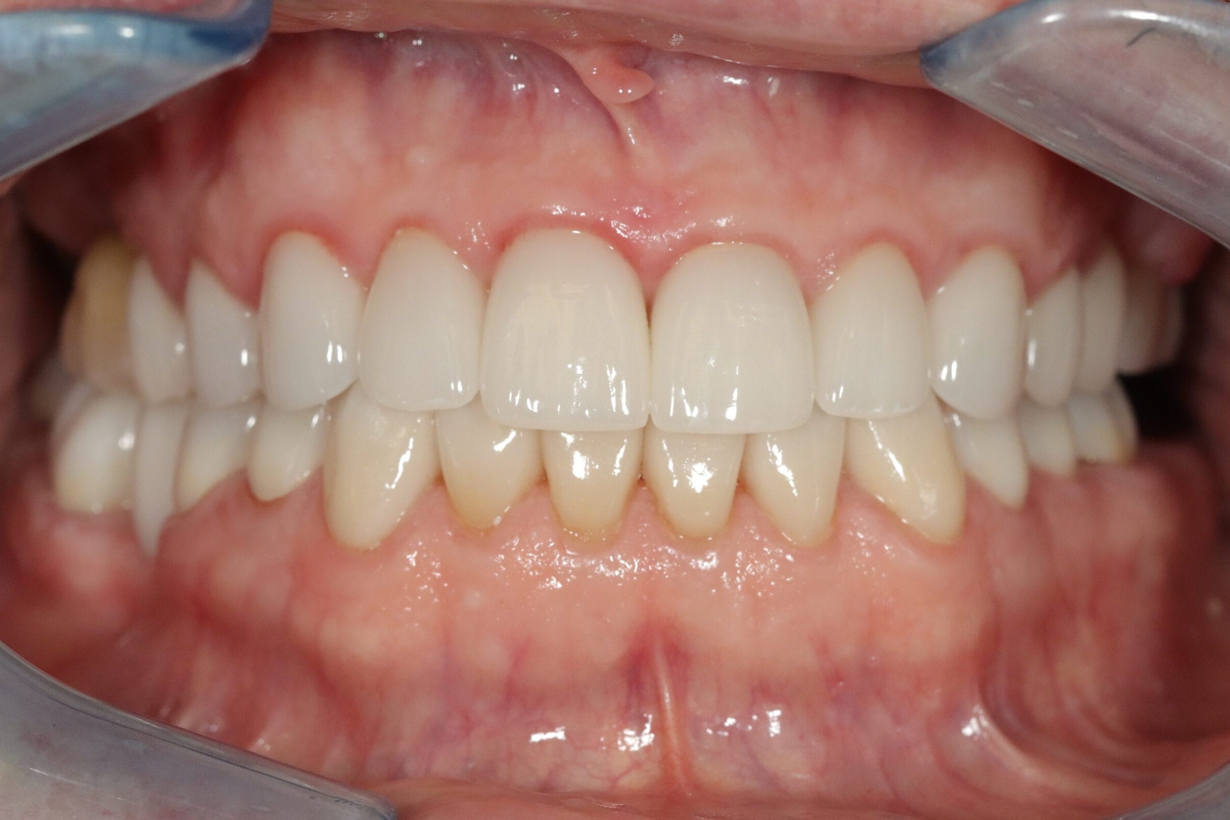 Case 14, after treatment