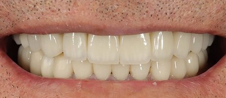 Case 5, after treatment