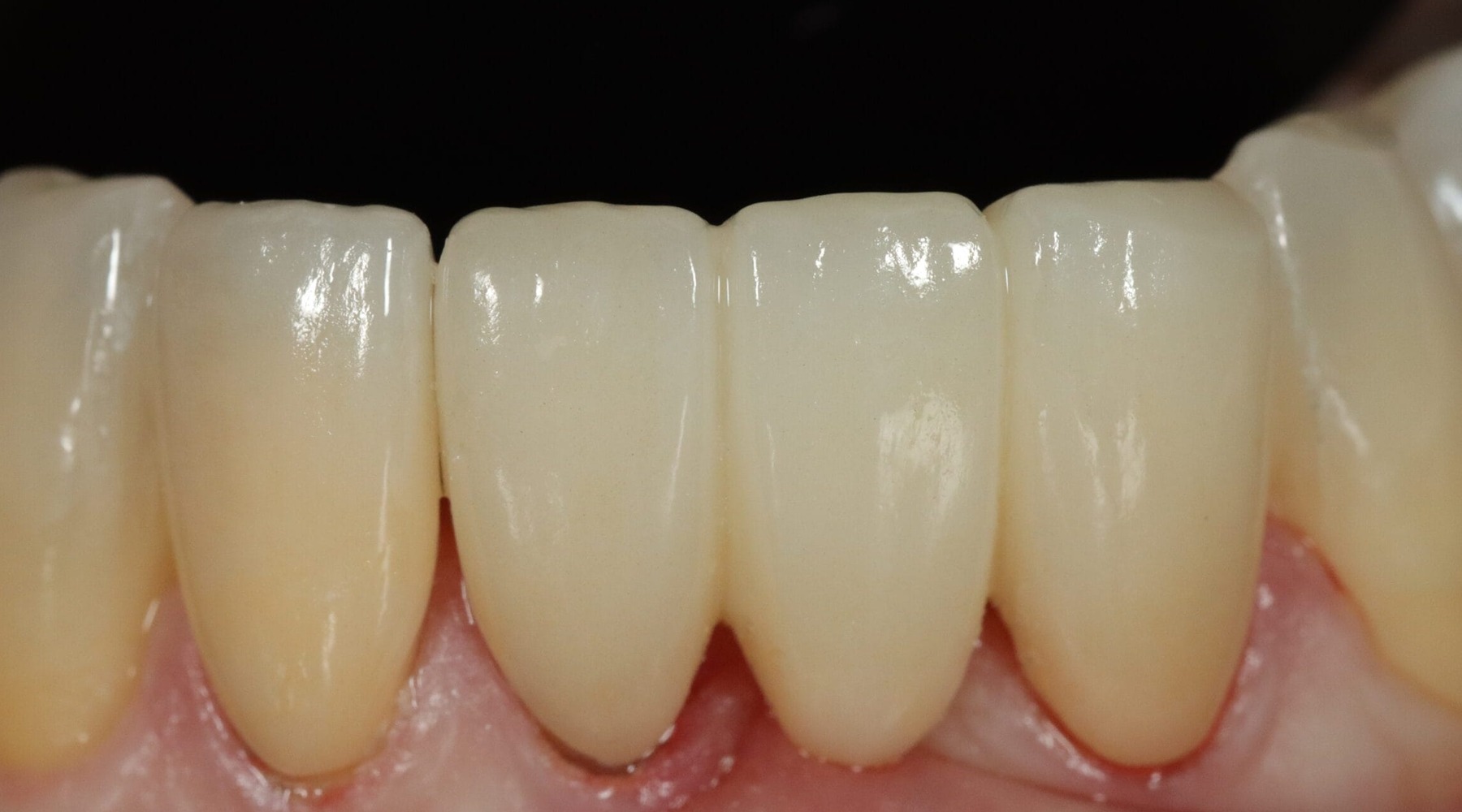 Case 15, after treatment