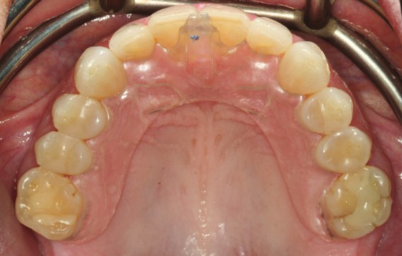 A clear, wire-free version of the Kois Deprogrammer in place