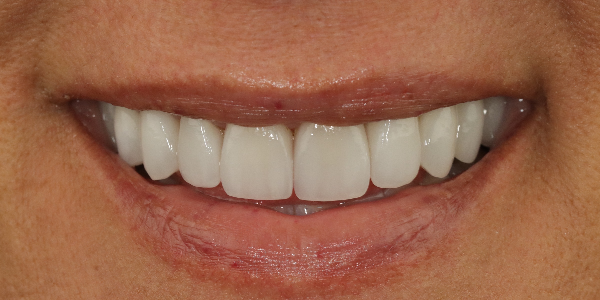 Case 4, after treatment