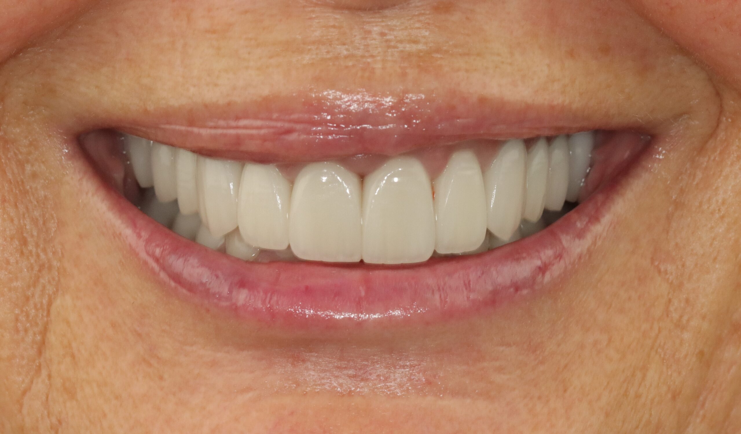 Case 1, after treatment